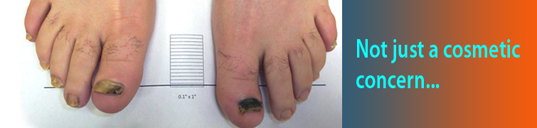 Nail fungus is not just a cosmetic concern